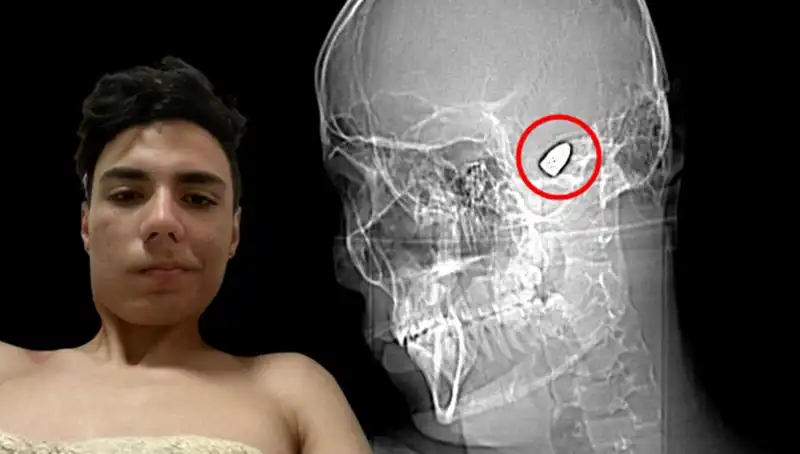 Kafasında Patlamaya Hazır Bomba Taşıyan Genç: Hayatı Tehlikede